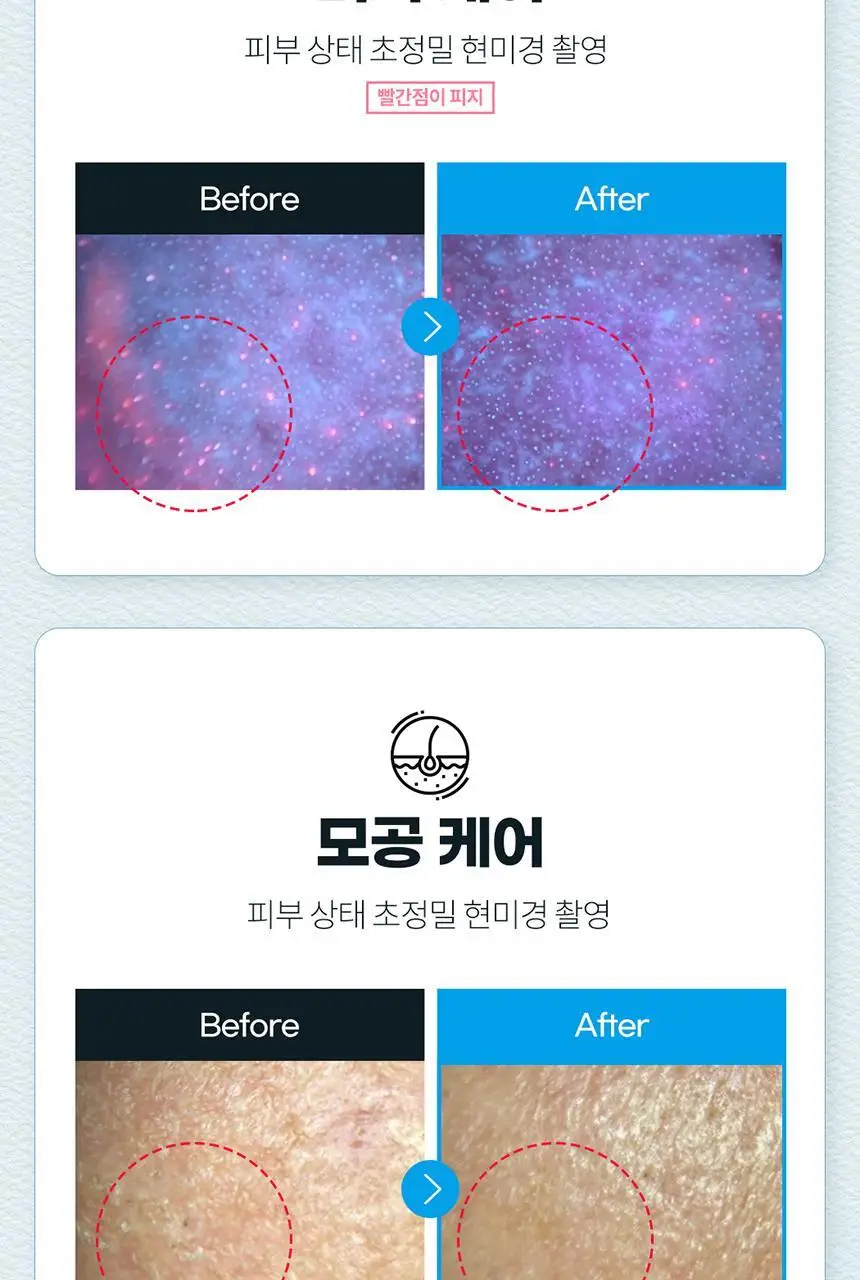 [블랙헤드 모공케어] H2 수소 아쿠아 워터 필링기 JOC-H2 상세페이지 13
